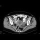 Tumour of the cervix of uterus, hydronephrosis: CT - Computed tomography